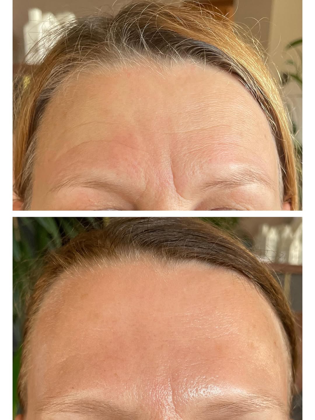 Efekt przed i po w okolicy czoła