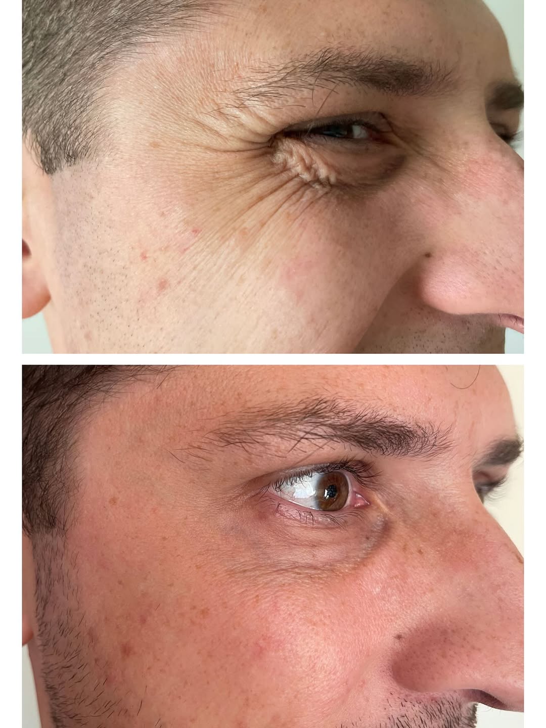 Efekt przed i po w okolicy oka