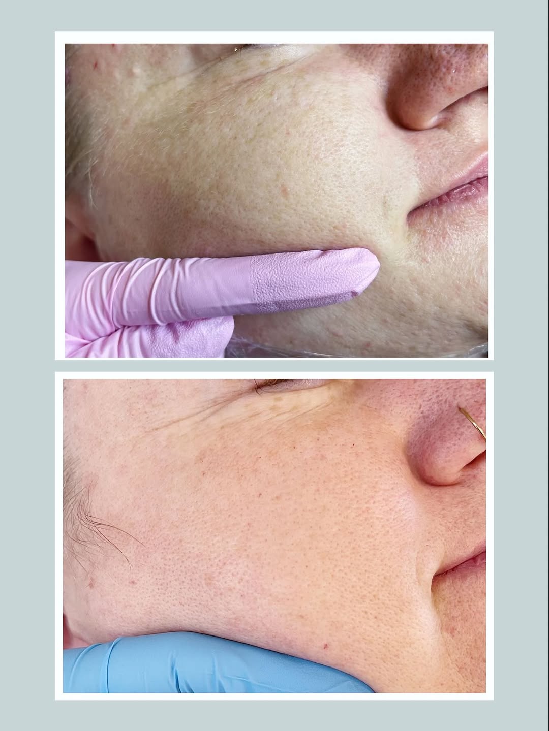 Efekt poprawy jakości skóry w ujęciu przed i po