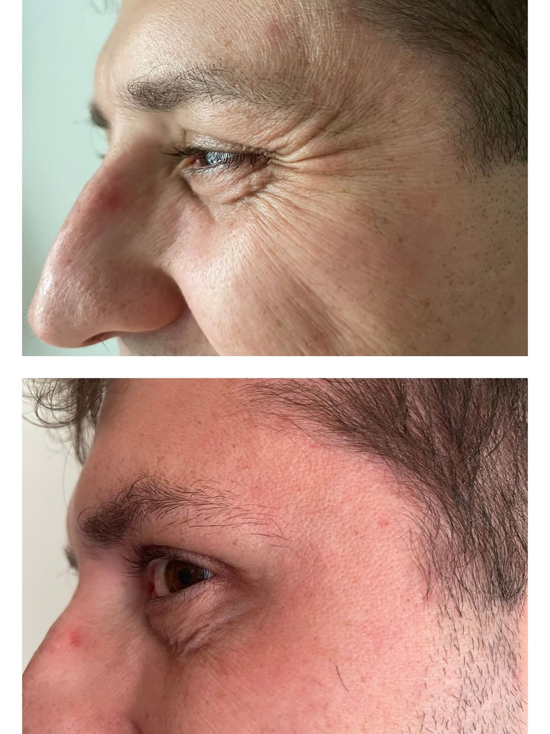 Przed i po w okolicy oka z profilu