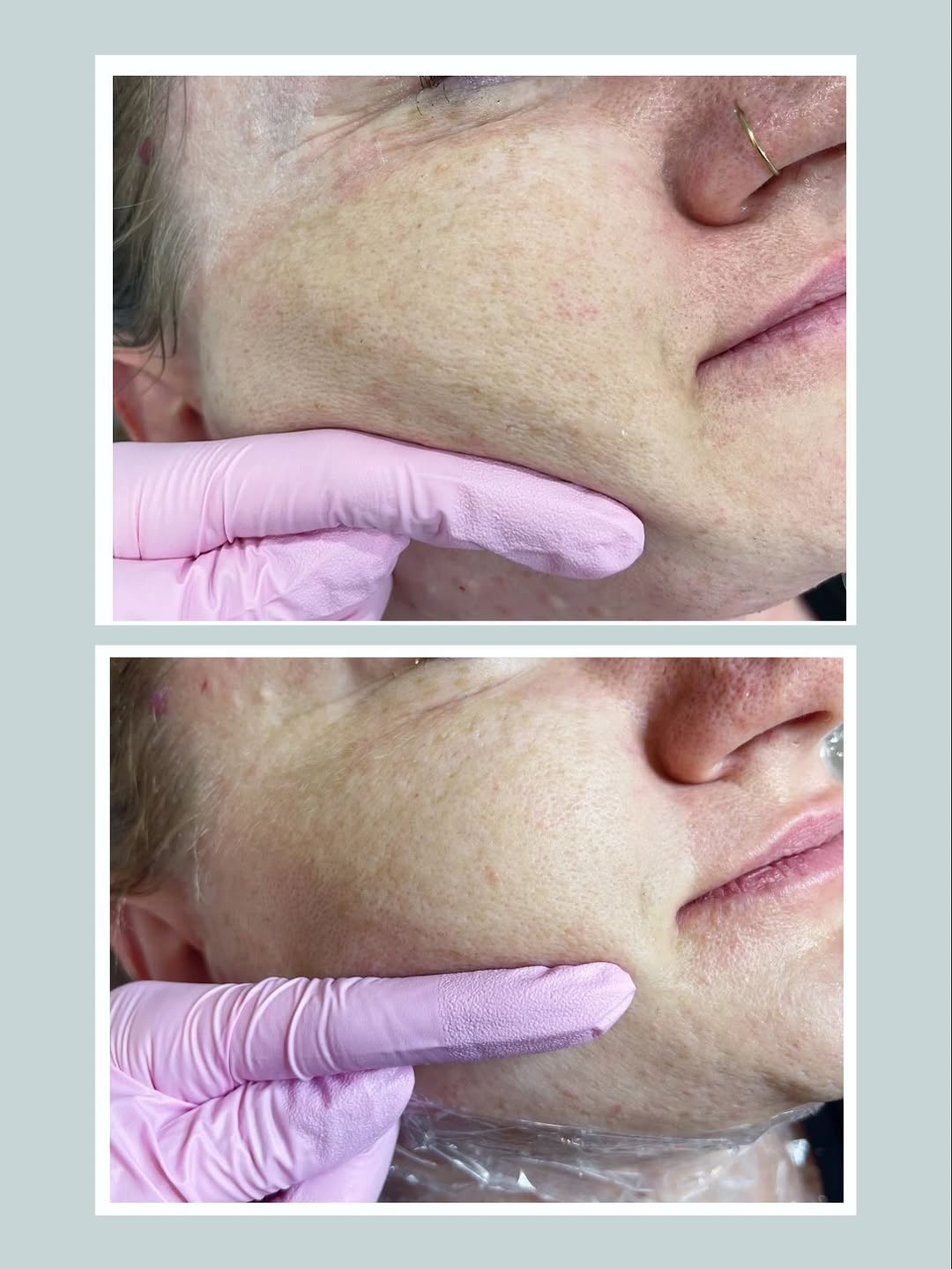 Materiał zabiegowy twarzy